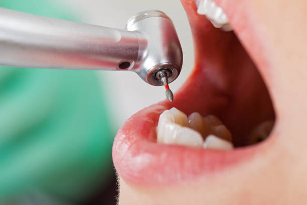 Best Emergency Wisdom Teeth Removal in Magee, MS
